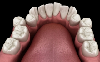 Illustration of crowded teeth