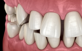 Illustration of crowded teeth