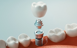 Digital image of a single dental implant