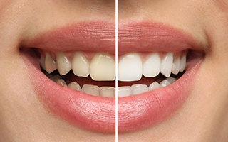 Smile that’s half-whitened to show before/after results