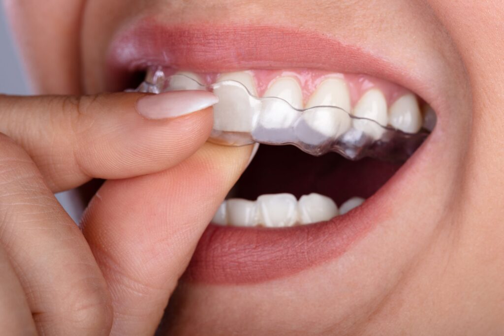 Woman removing clear aligners from top arch