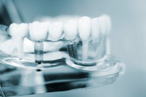 Dental implants shown anchored into gums.